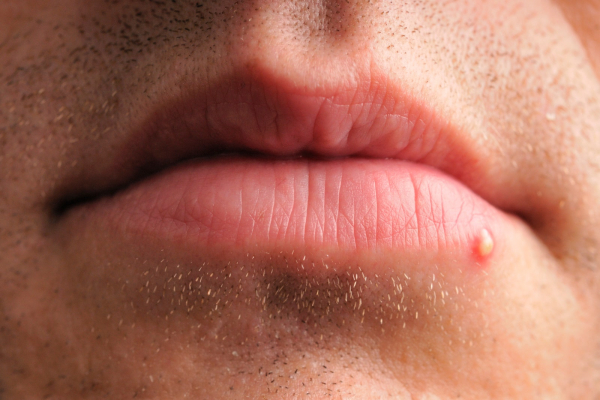 Pimple or zit on the lips on the lip area of a person.