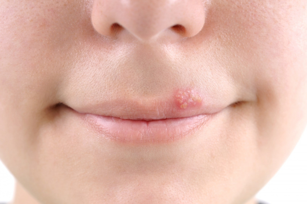photo of a person with a cold sore from herpes simplex virus 1